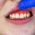 Increased Risk of Gum Disease and Tooth Decay