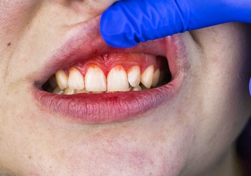 Increased Risk of Gum Disease and Tooth Decay